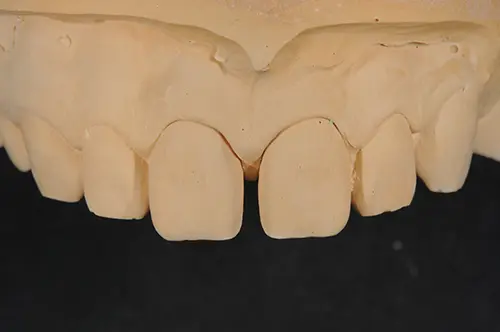 すきっ歯の模型
