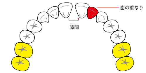 すきっ歯と前歯の重なりの図解