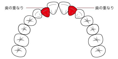 スペースのない歯の重なりの図解