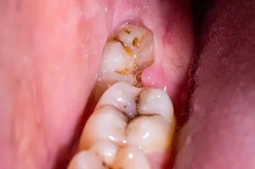 虫歯の歯