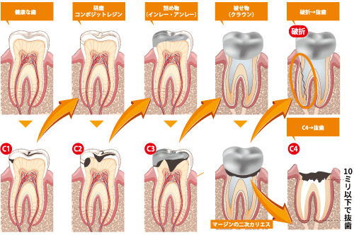 虫歯の悪化サイクル