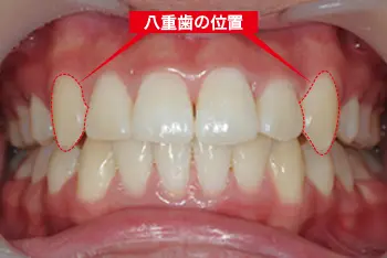 八重歯矯正前の正面写真