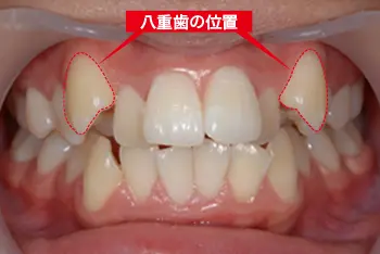八重歯矯正後の正面写真