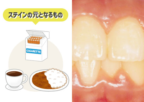 歯が黄ばむ原因と改善方法 | 加古川の歯医者 加古川アップル歯科
