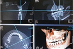 歯科用CT写真