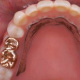 メタル人工歯