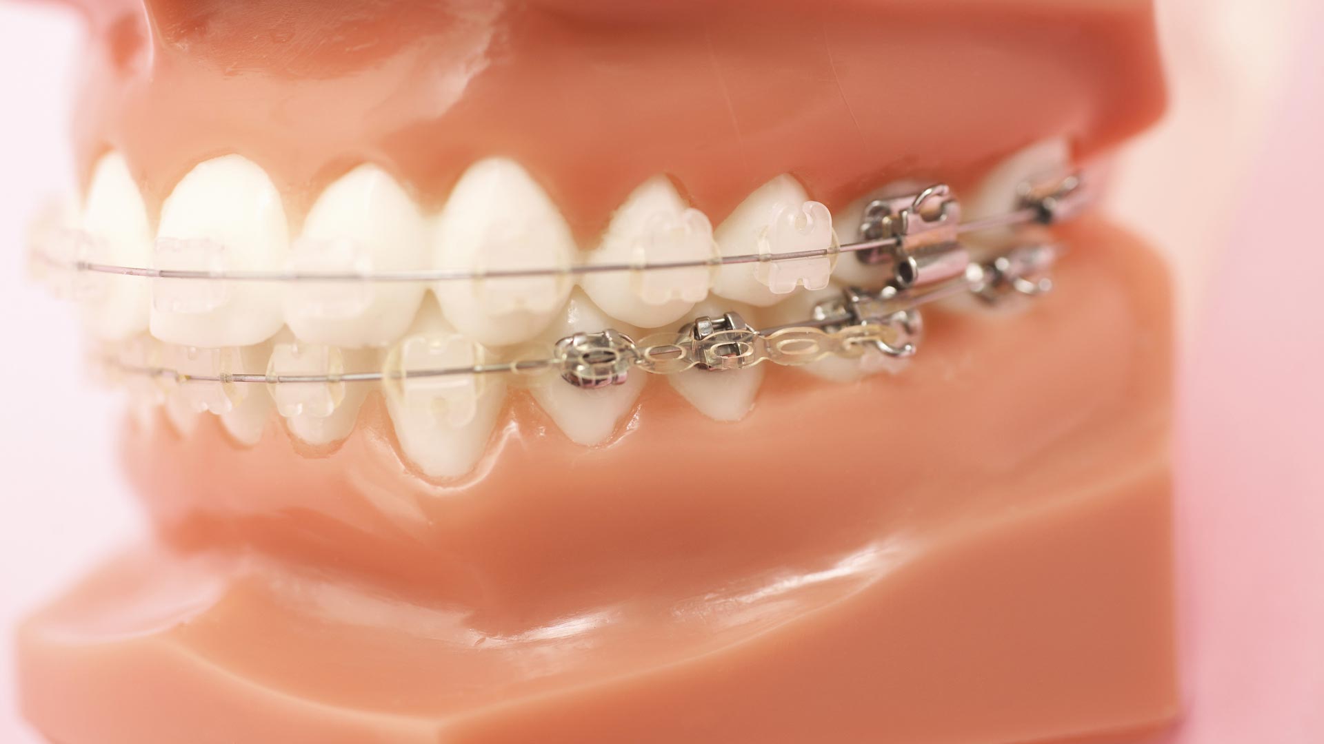 歯列矯正装置の種類 | 加古川市の歯医者 加古川アップル歯科